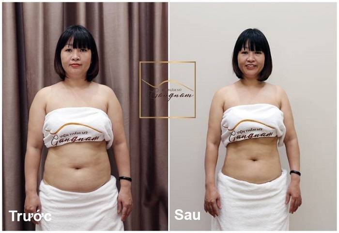 Giảm béo mặt cấp tốc bằng công nghệ giảm béo mặt Smart Lipo