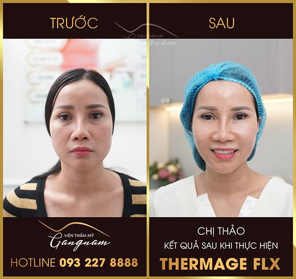 Chị Thao trước và sau khi căng da với công nghệ Thermage FLX