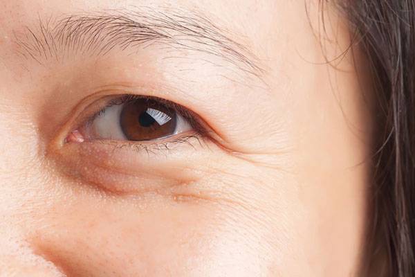 Trẻ hóa da vùng mắt giúp xóa mờ-nếp nhăn-là một trong những nguyên nhân chính khiến phụ nữ trông già trước tuổi