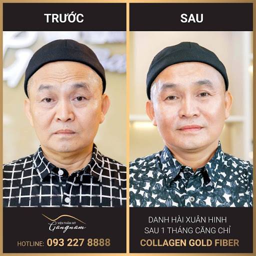 Hình ảnh sau 1 tháng thực hiện căng chỉ Collagen Gold Fiber của danh hài Xuân Hinh