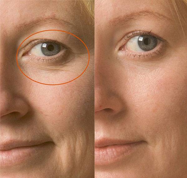 Căng da vùng mắt bằng chỉ collagen là phương pháp được các chuyên gia thẩm mỹ đầu ngành đánh giá cao